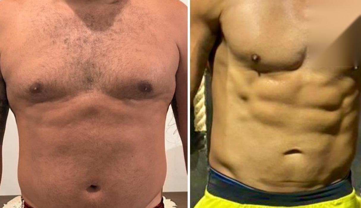 Registro de acompanhamento, região abdominal