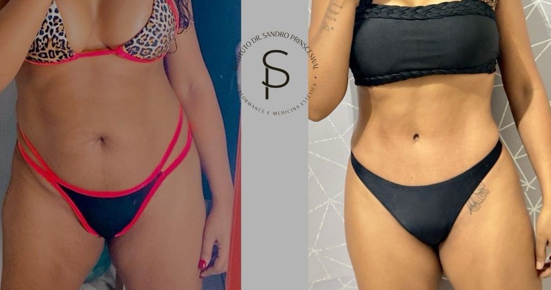 Registro de acompanhamento, região abdominal e flancos